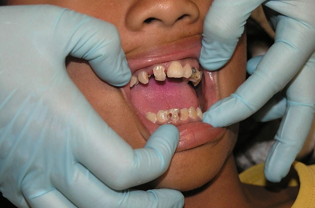 Strategien gegen Zahnschmerzen: Hausmittel, Akupressur und Medikamente